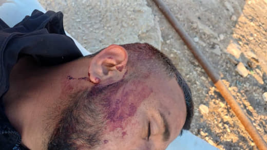 Injuries among citizens as a result of a settler attack on the village of Umm al-Khair in the West Bank a short while ag