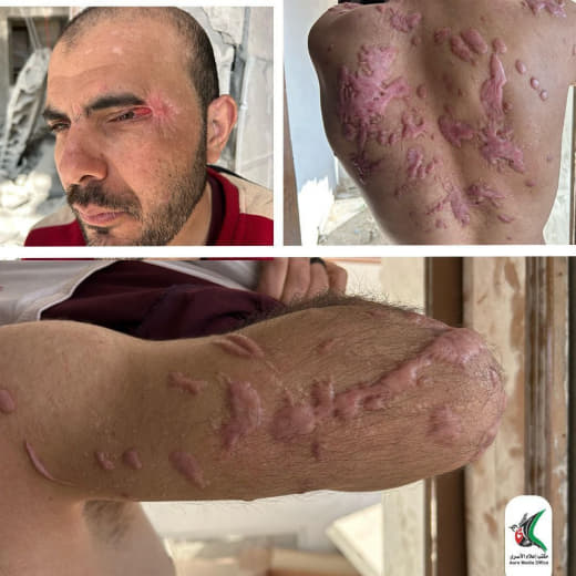 The Zionist occupation burns a Palestinian prisoner from Gaza with extremely hot chemicals, and he also lost his sight i