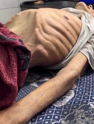 A new death due to hunger in Gaza 🇵🇸