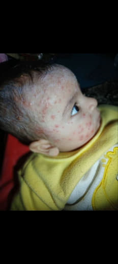 My heart hurts today 💔 My little sister's face looks like this, and the redness gets worse right in front of my eyes. 😔 