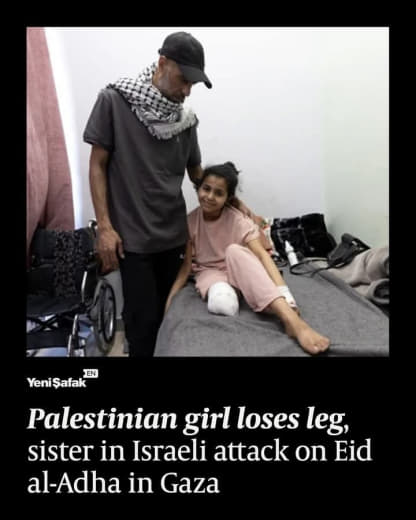 Palestinian Sham Iyad Teysir Azzam, who lost her right leg after Israeli forces violated a ceasefire and targeted a park
