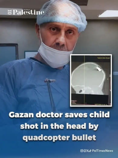 Gazan doctor Hisham Abu Hadda has successfully performed surgery to remove a bullet from the brain of a one-year-old chi