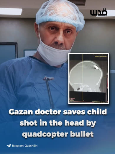 Gazan doctor Hisham Abu Hadda has successfully performed surgery to remove a bullet from the brain of a one-year-old chi