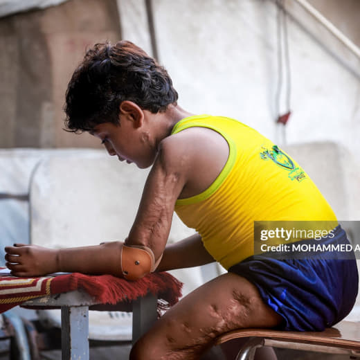 👤 mohammed_abusalama 📝 Kinan-Abu-Jabba-Uses-Prosthesis Palestinian child Kinan Abu Jabba sits for a portrait inside a ma
