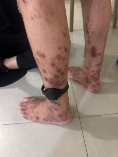 Palestinian ex-prisoner Iyad Ashraf Da'is from Jerusalem shows severe skin conditions after being released from Israeli 