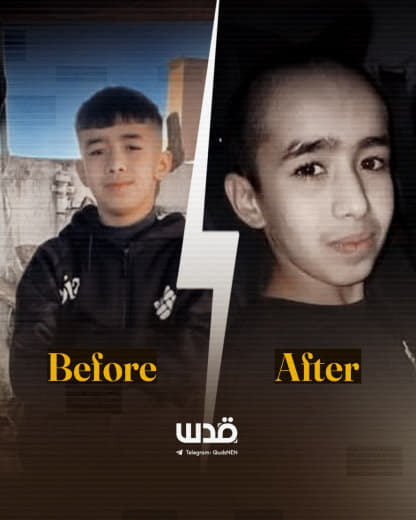 A before-and-after photo of 13-year-old Wadih Khawira from Ramallah, taken after his release from Israeli prison, where 